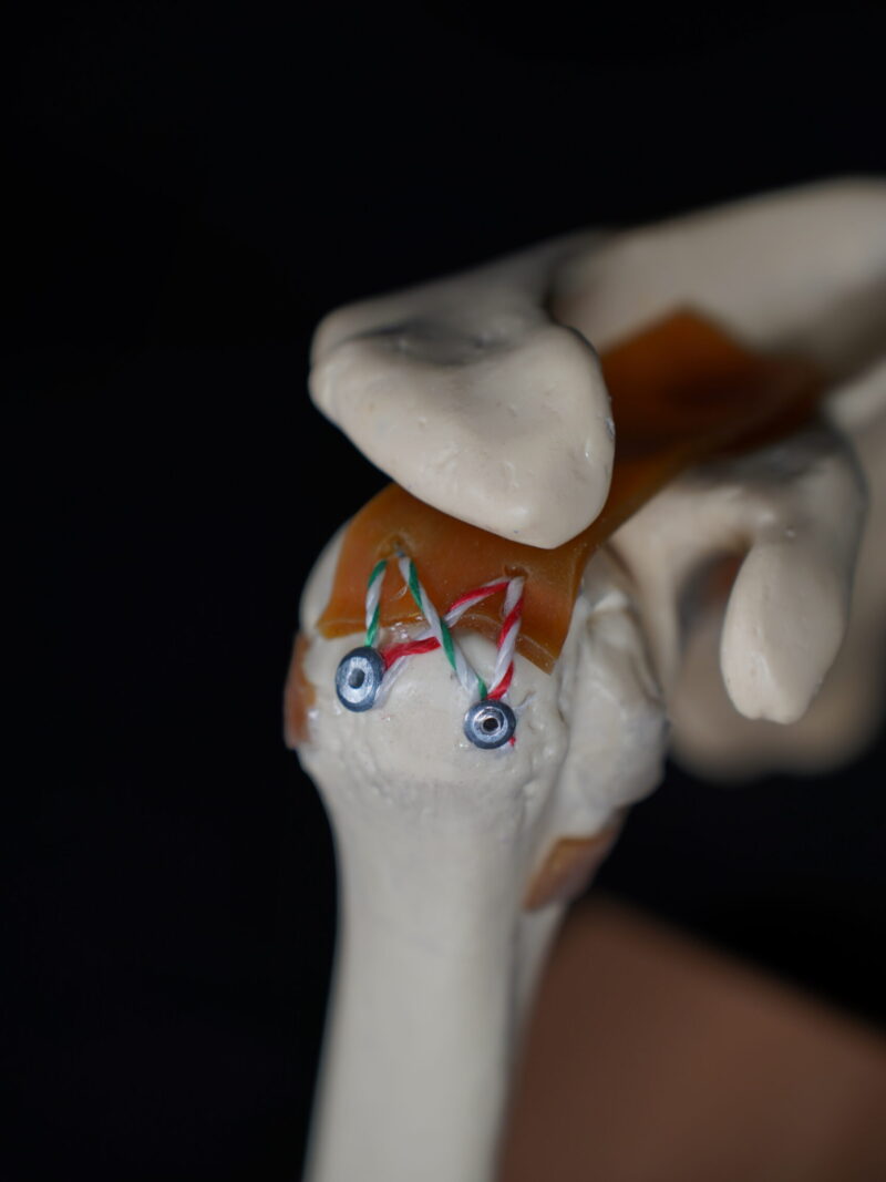 Rotator Manşet Yırtığı Onarımı