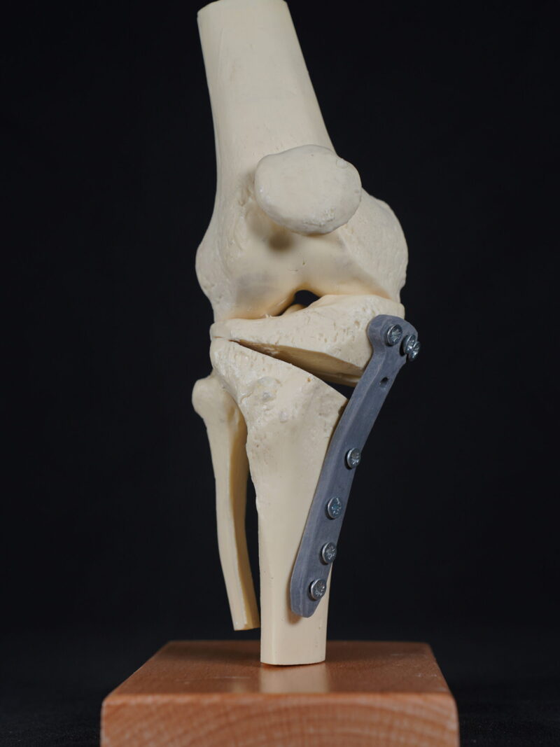 Yüksek Tibial Osteotomi