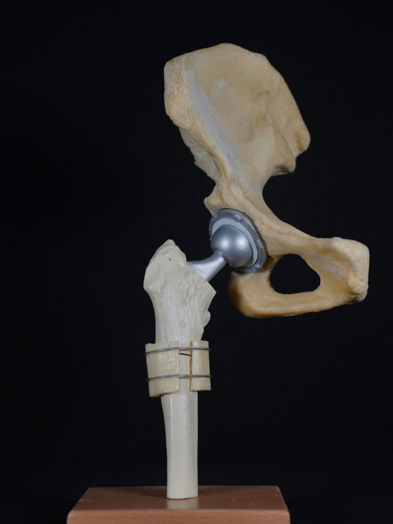 Displastik Kalçada - Total Kalça Protezi