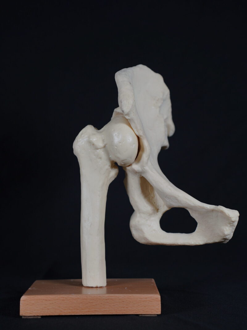 Erişkin Displastik Kalça Eklemi