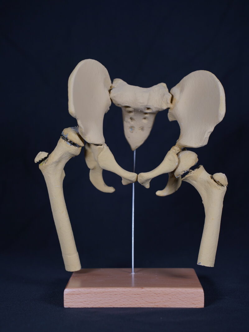Pediatric dysplastic hip model for orthopedic education and deformity teaching