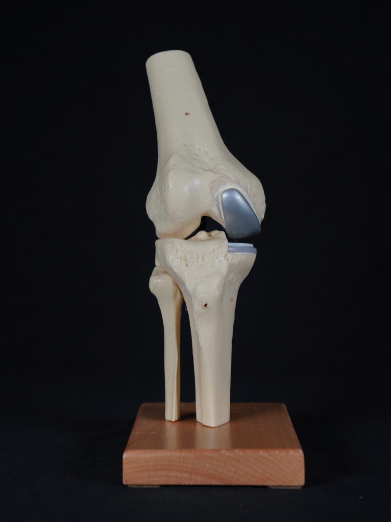 Unicondylar knee prosthesis model for orthopedic education and implant demonstration
