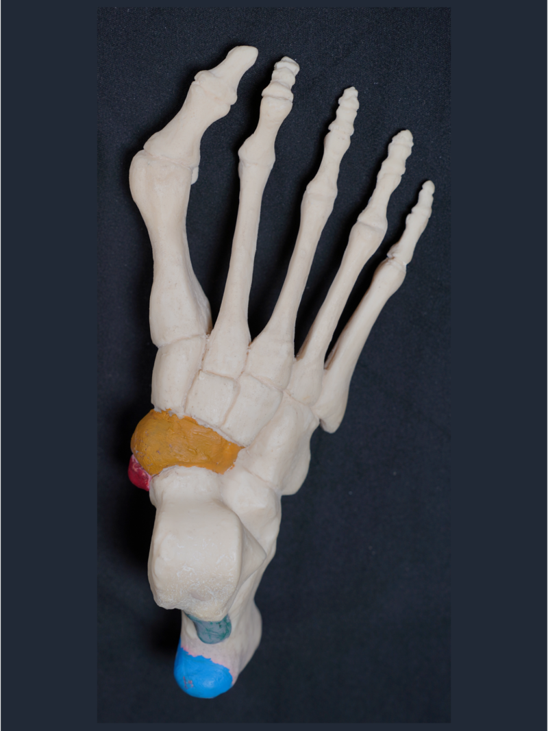 Hallux valgus foot model for orthopedic education and deformity demonstration