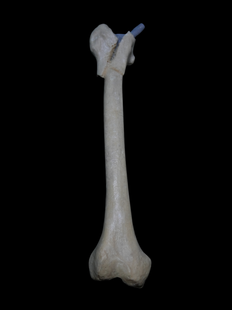 Periprostetik Kalça Kırığı – Femur