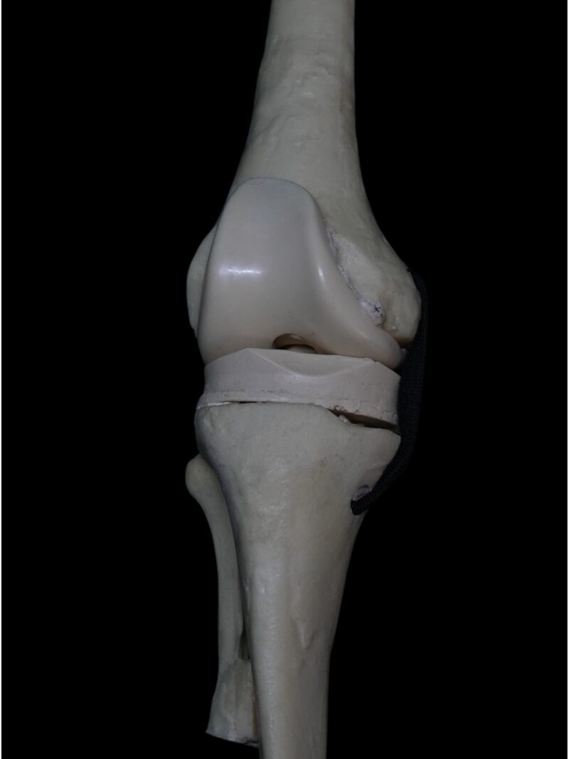 Revision total knee prosthesis