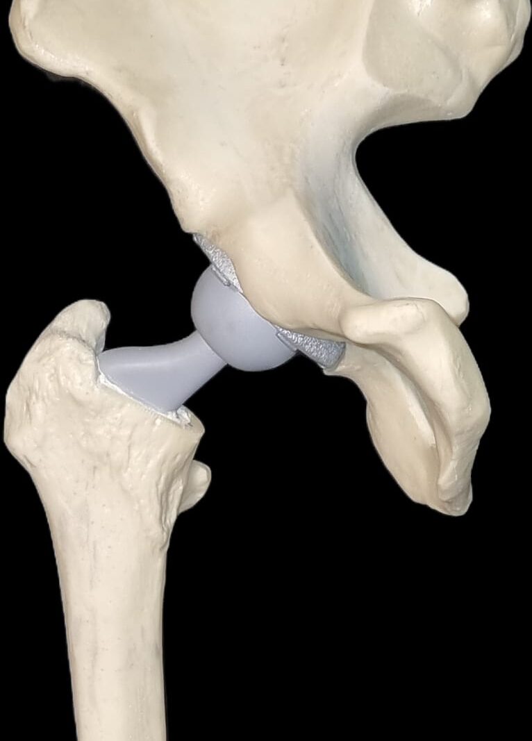 Total hip prosthesis model demonstrating hip implant components for orthopedic education