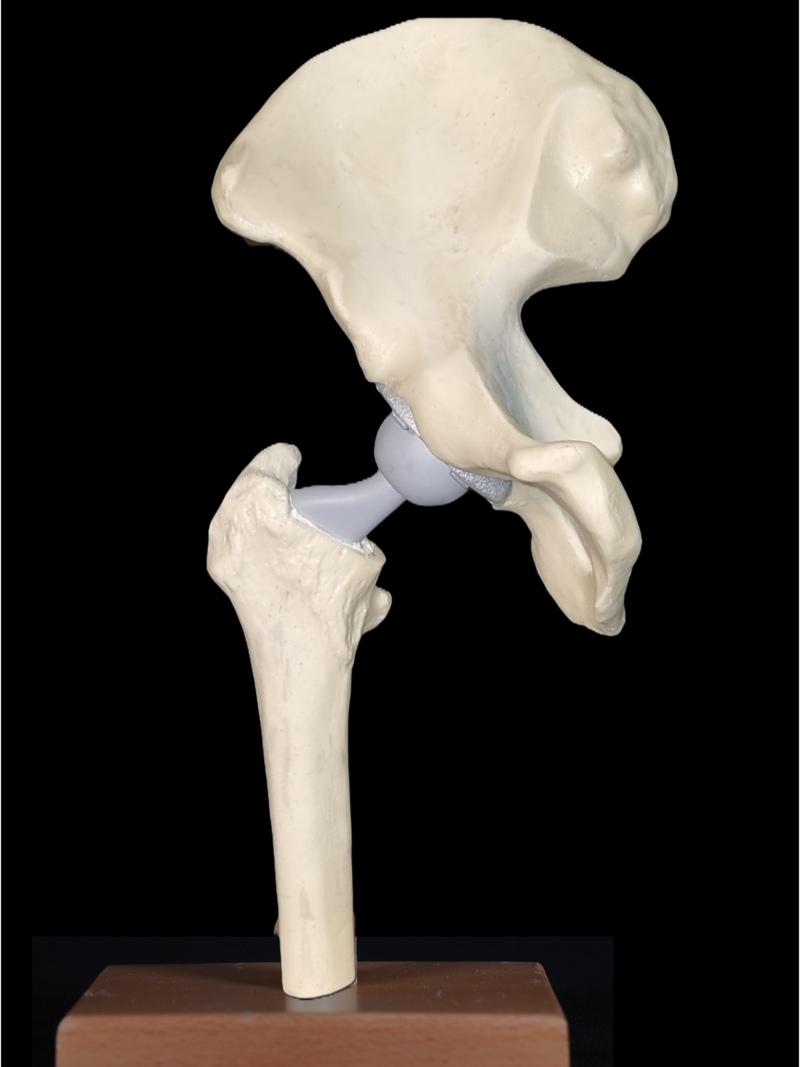 Total hip prosthesis model demonstrating hip implant components for orthopedic education
