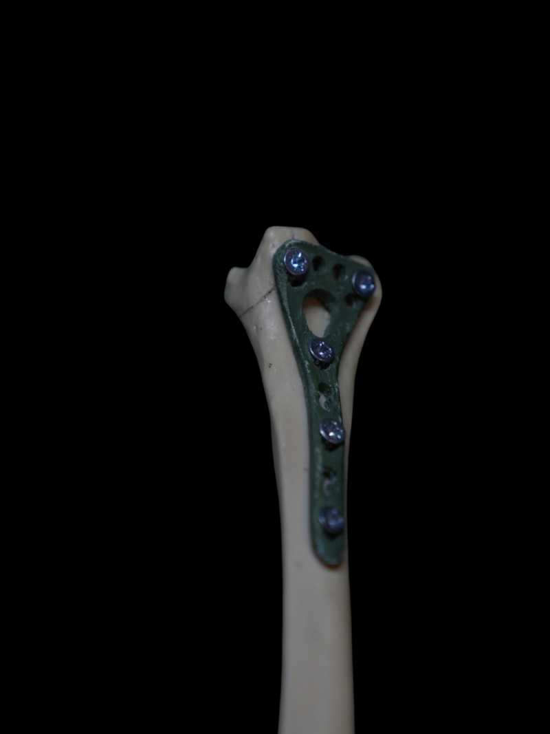 Distal Radius Kırığı - Ameliyat Edilmiş