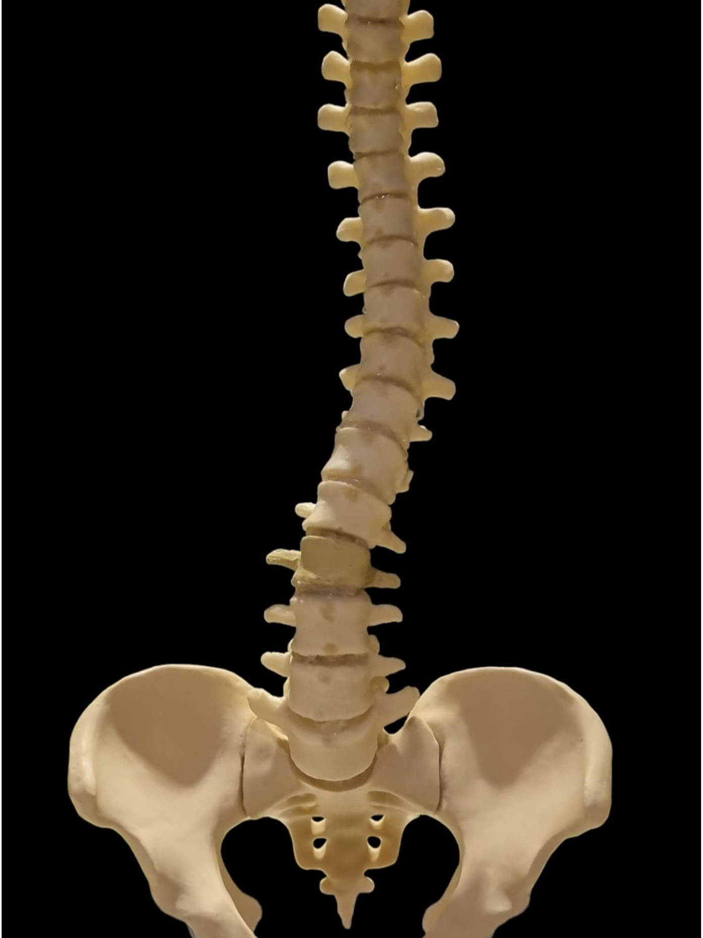 Thoracolumbar spine demonstrating a severe lateral curvature accompanied by pathological vertebral rotation